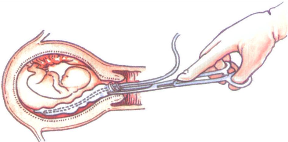 羊膜腔穿刺术引产步骤图片
